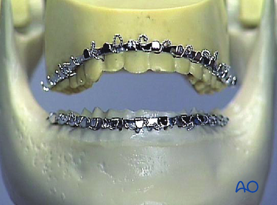 Arch bars applied to maxilla and mandible