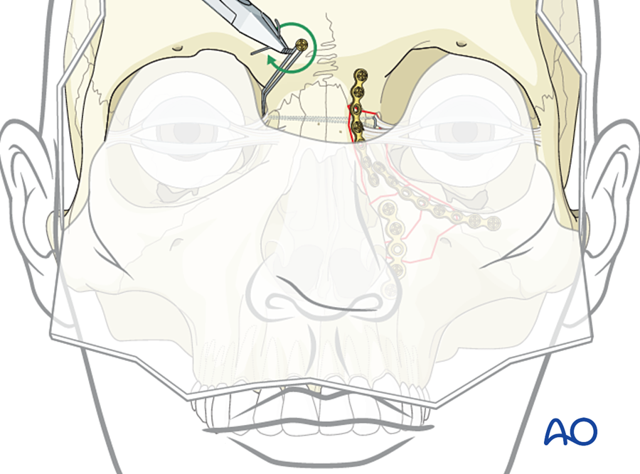 Transnasal canthopexy wire