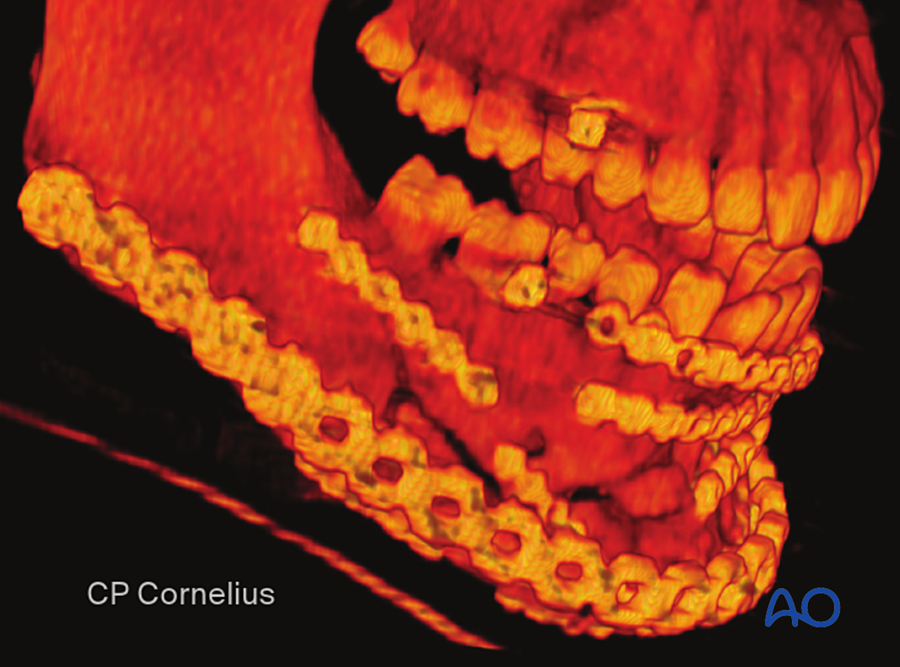 3D CT of the final construct