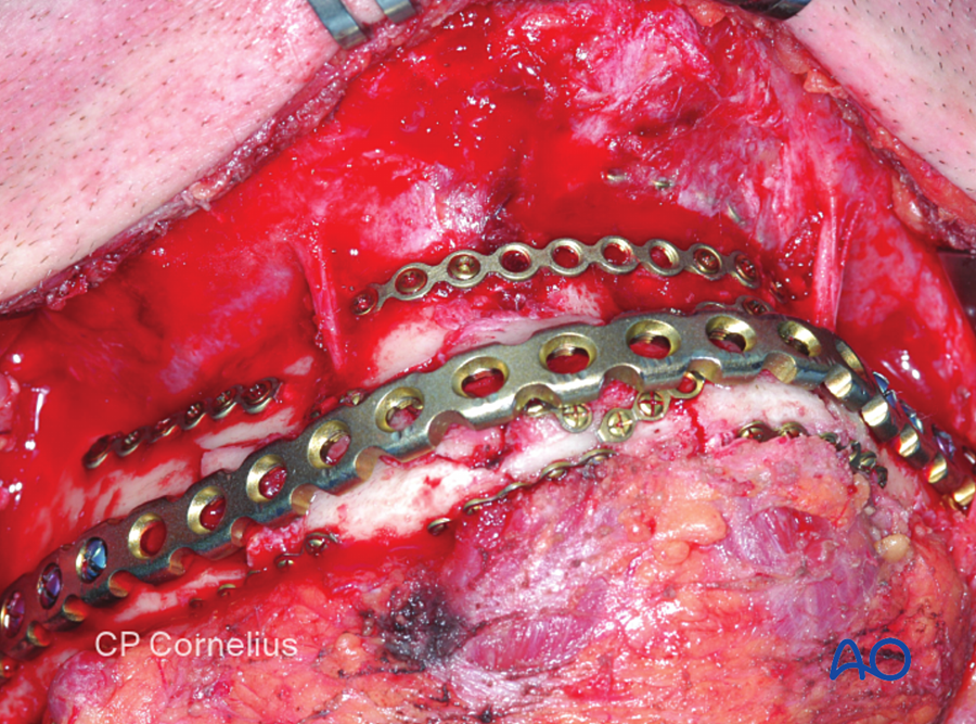 Reconstruction plate on a comminuted mandibular fracture