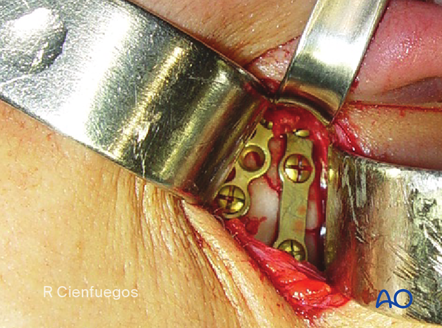 Two plates on a condylar process fracture