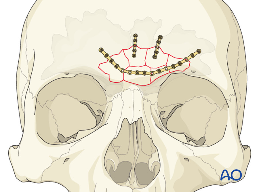Fixation of an anterior table frontal sinus fracture