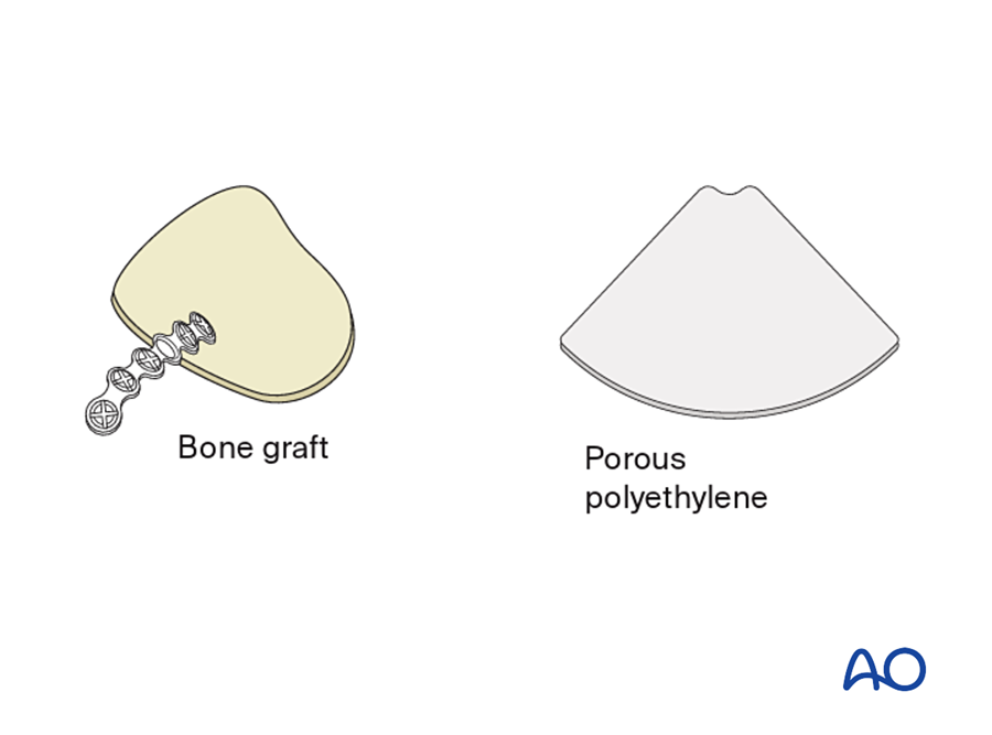 Bone grafts and porous polyethylene implants
