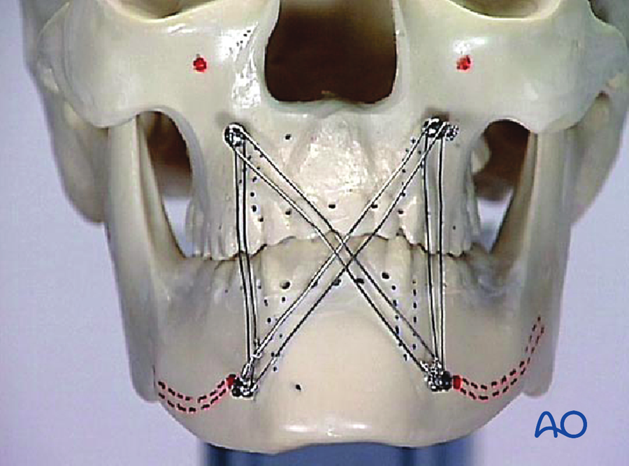 IMF screws on a dry skull