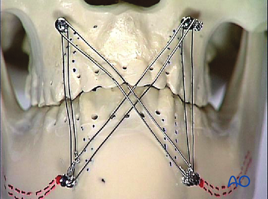 Wire in X pattern between IMF screws