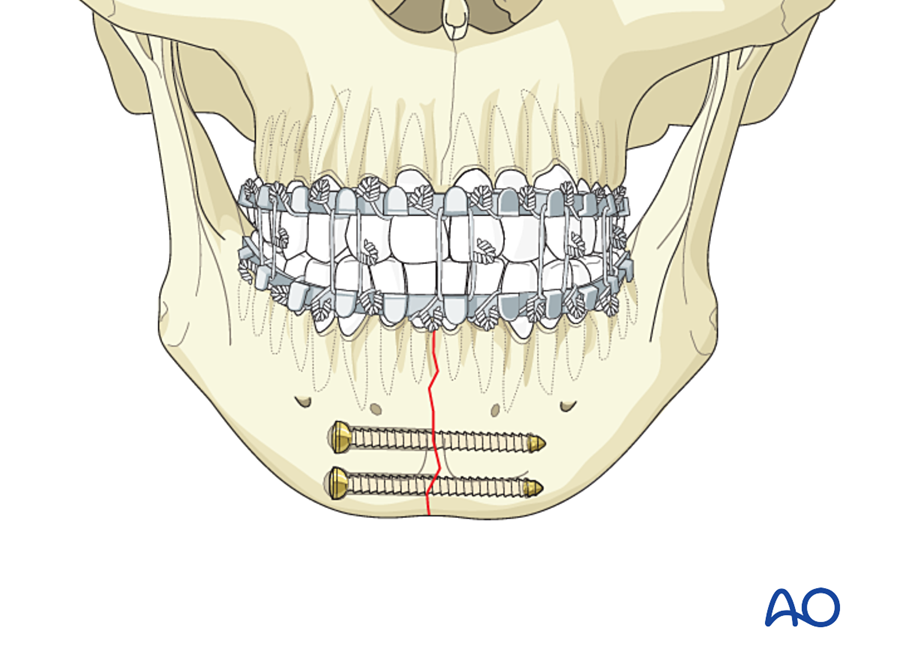 Two lag screws across the symphysis