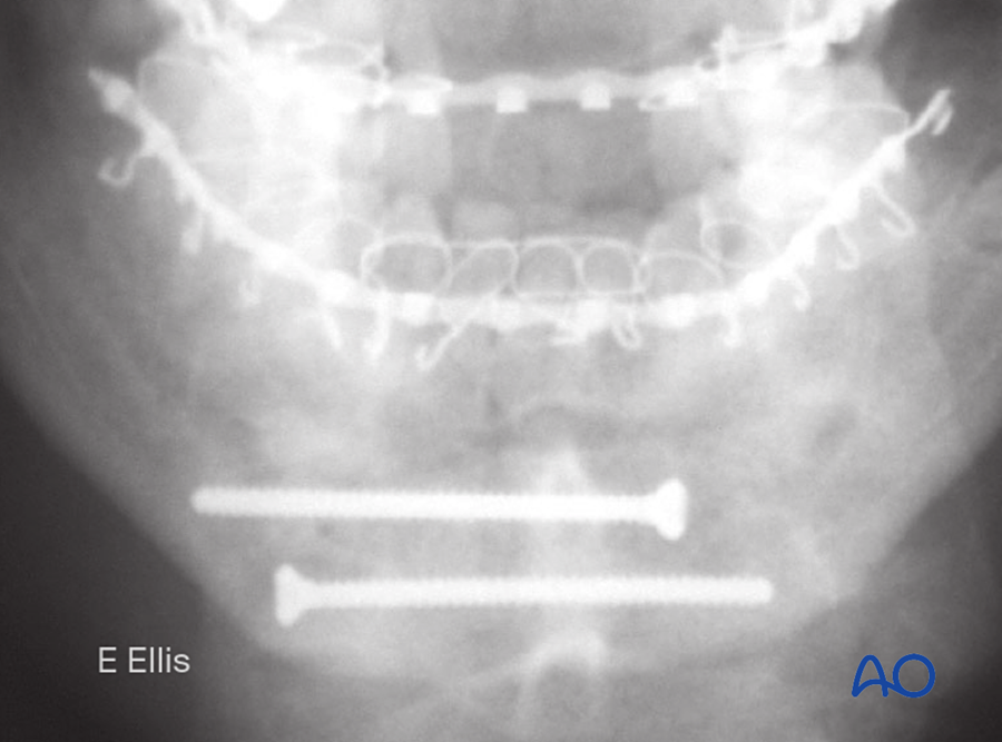 Radiograph of lag screw fixation