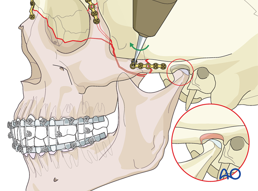 Fixation of a Le Fort III fracture