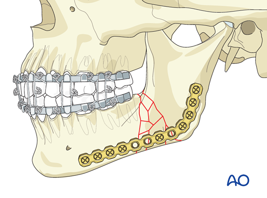 Load-bearing osteosynthesis