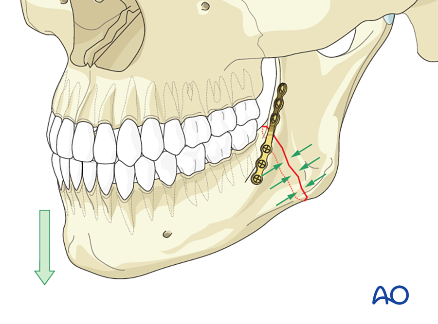 Load-sharing osteosynthesis