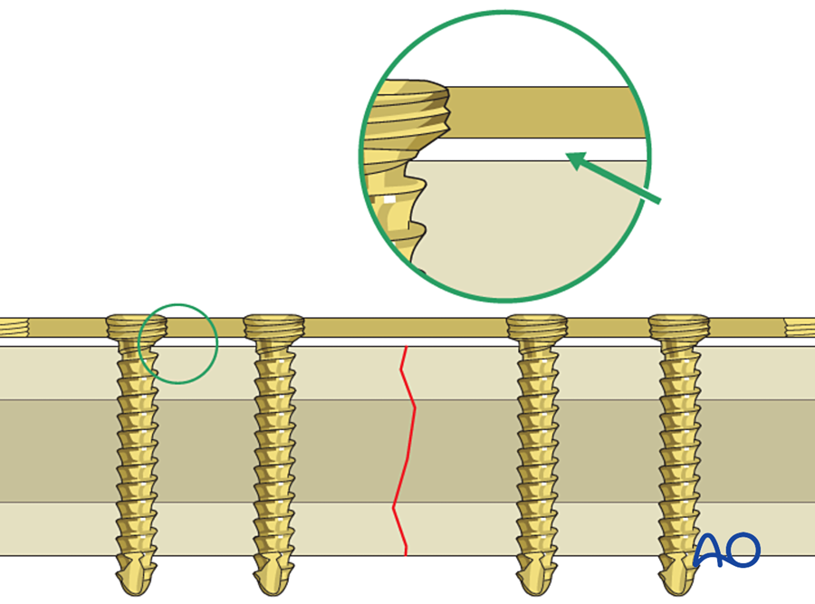 Locking screws engaged in the plate