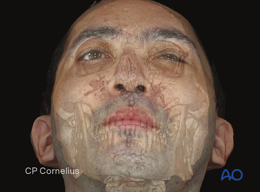 Biomechanics of the midface