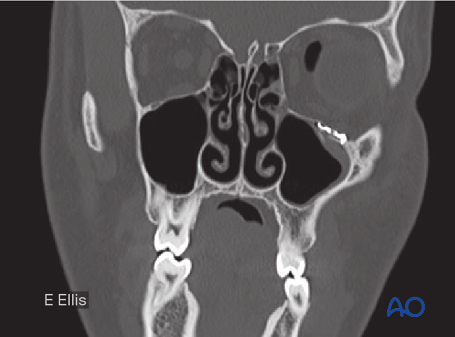 Postoperative coronal CT of orbital floor plate