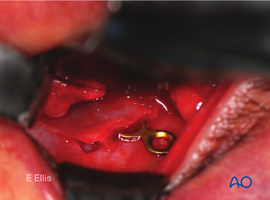 Intraoperative photograph of orbital floor fixation