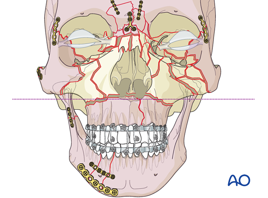 Panfacial sequencing in upper and lower halves