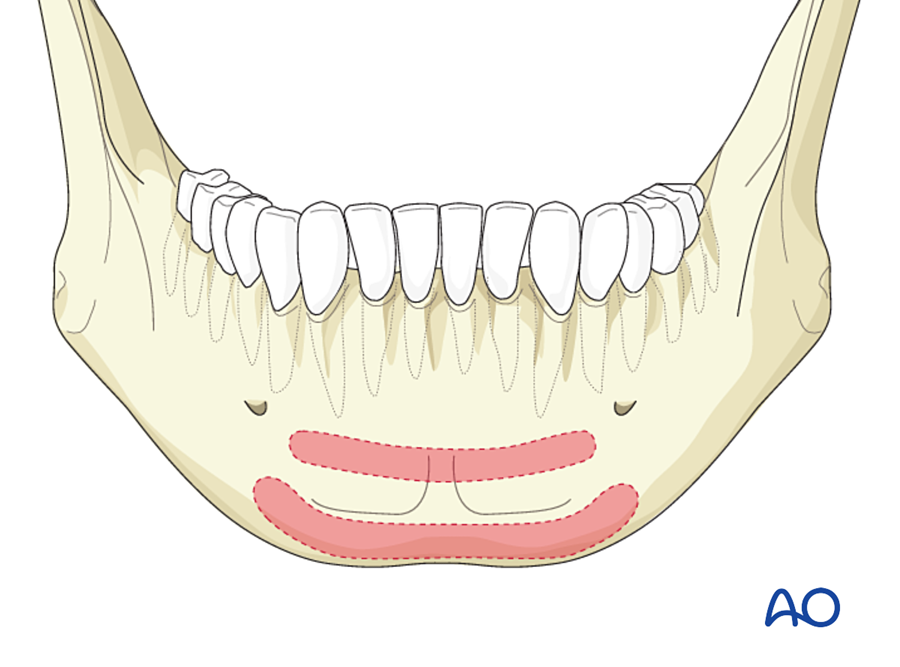 Champy lines for symphysis fractures