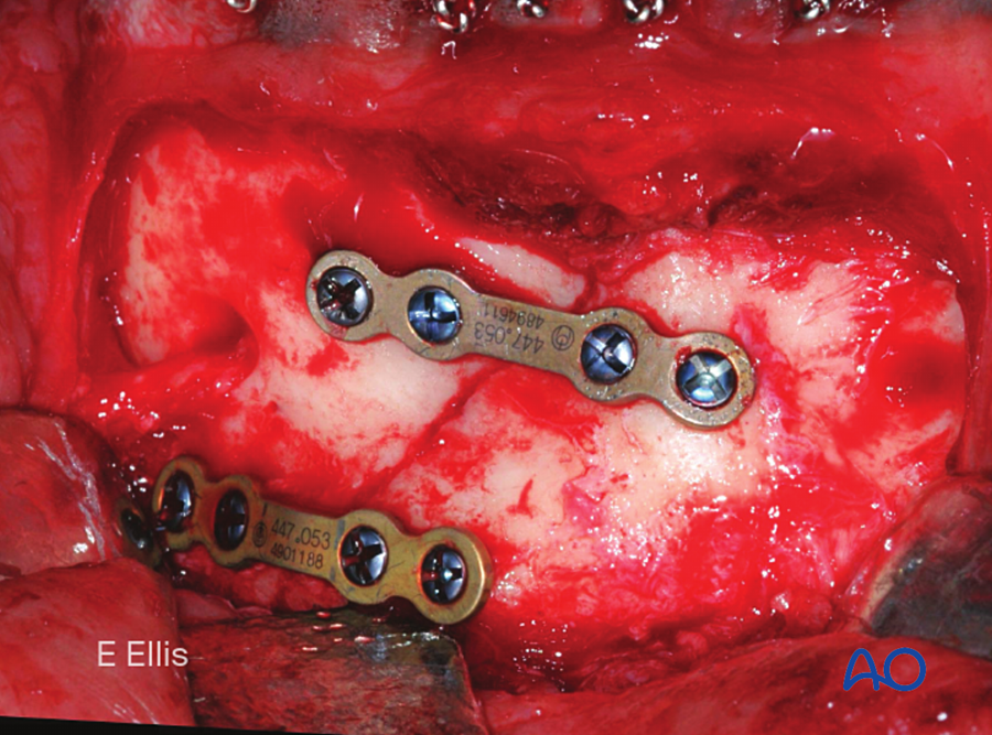 Clinical photograph of two mandibular miniplates