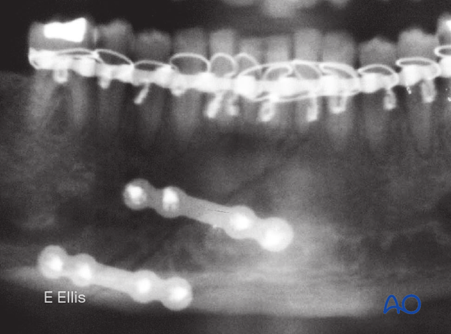 Radiograph after two-plate fixation