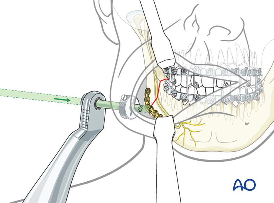 Transbuccal system