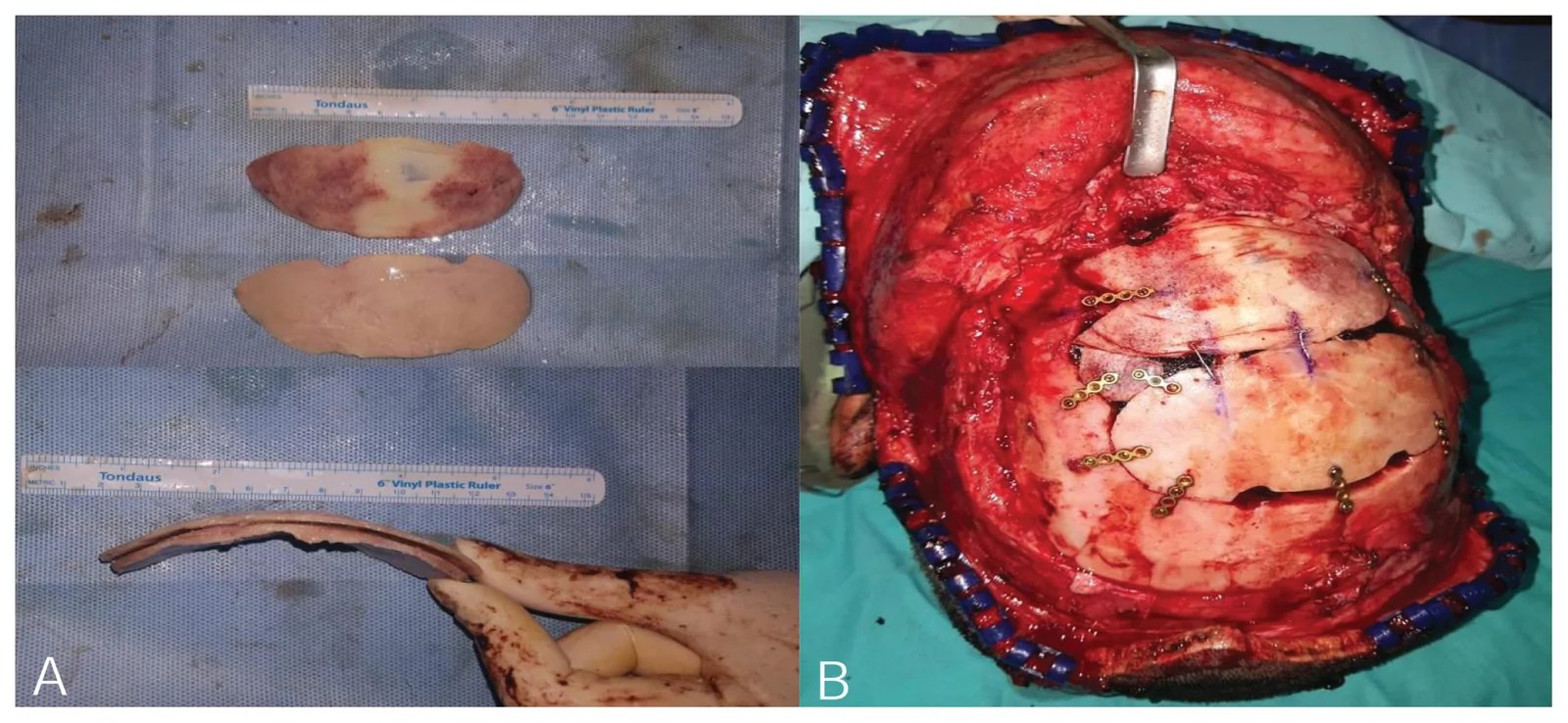 Splitting of calvarial bone and cranial reconstruction