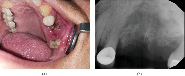 Exposed necrotic bone of the maxilla and periapical radiograph