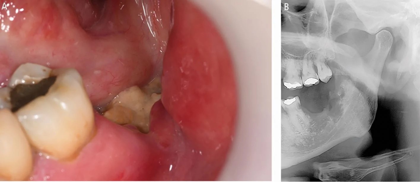 Osteoradionecrosis of the mandible, clinical and radiograph