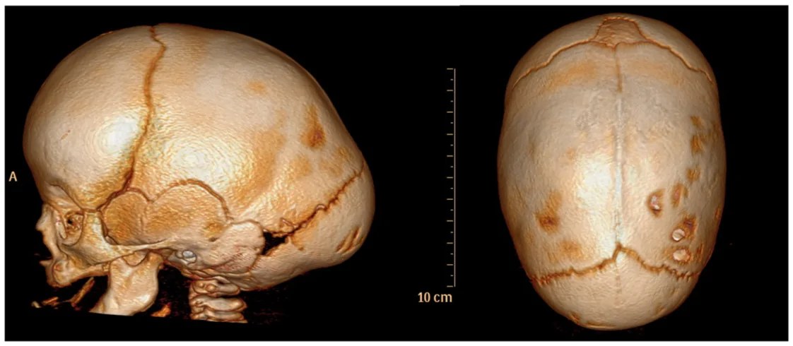 3D CT of scaphocephaly
