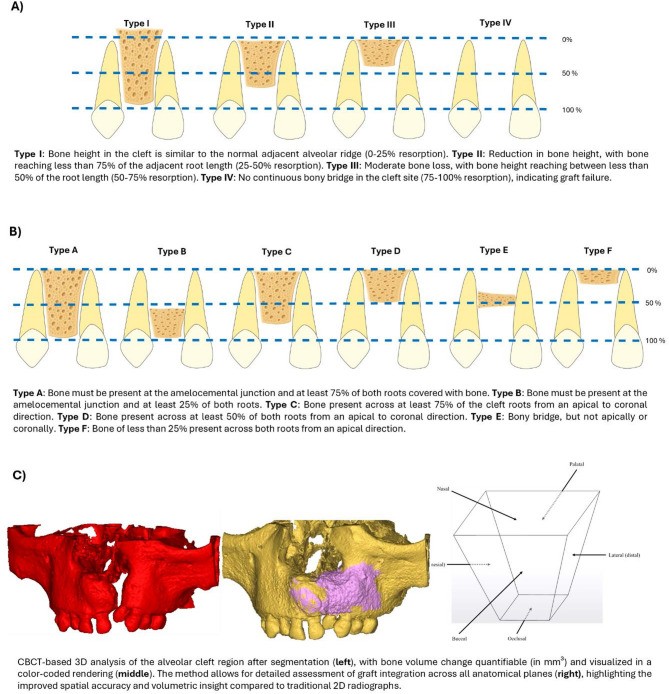 Diagram of the Bergland scale and three-dimensional assessment of an alveolar bone graft