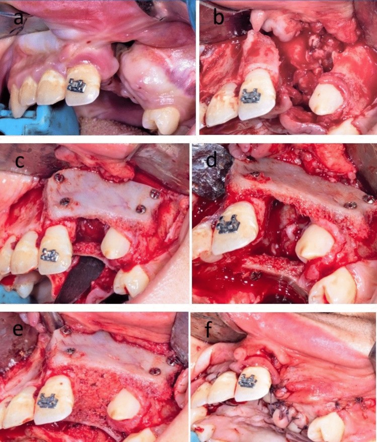Alveolar cleft grafted with two cortical blocks and cancellous bone between them