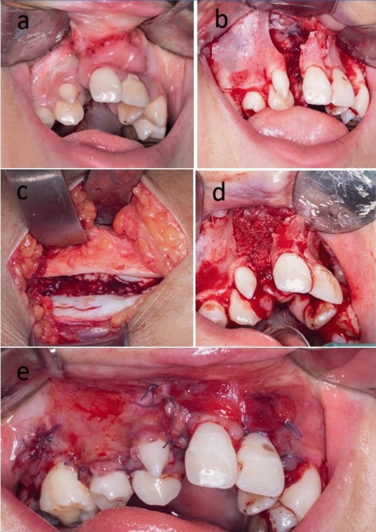 Alveolar cleft grafted with cancellous bone from the iliac crest