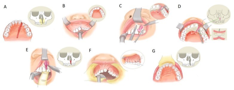 Drawings of the steps of alveolar cleft closure with gum flaps
