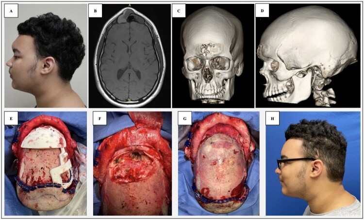 Split calvarial bone graft used to reconstruct the frontal sinus wall