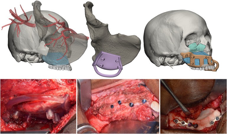 Planned iliac crest free flap for midface reconstruction