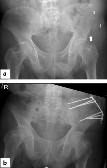 Radiograph of a fracture of the anterior superior iliac spine after graft harvest
