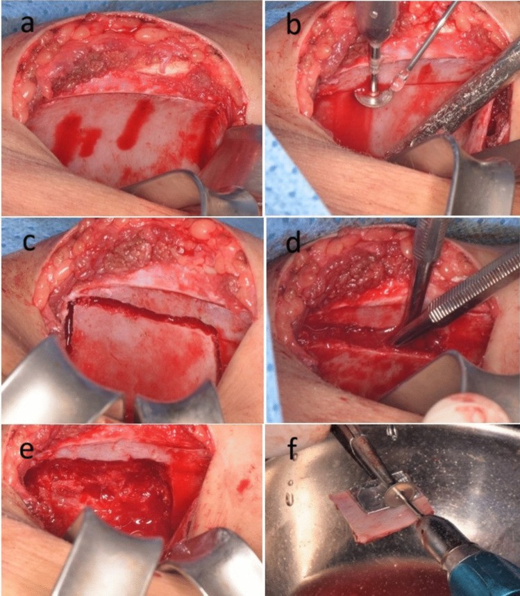 Harvest of a corticocancellous block from the anterior iliac crest