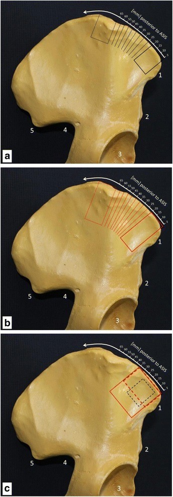 Model of the ilium showing where the graft is taken in relation to the anterior superior iliac spine