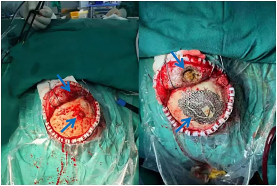 Titanium mesh cranioplasty after removal of a skull tumor