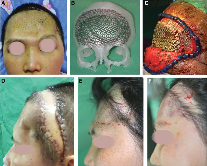 Exposed titanium mesh on the forehead, and its treatment with a new mesh and a free flap