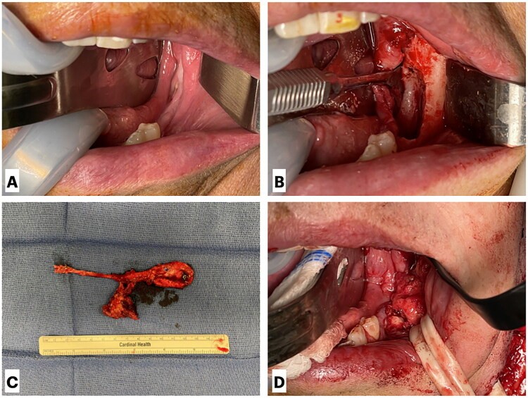 Medial femoral condyle free flap for a small mandibular defect