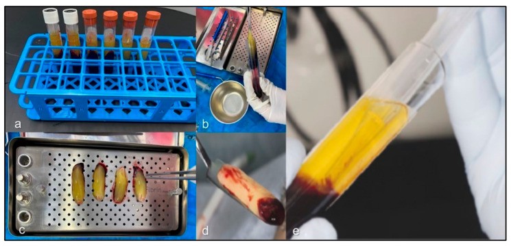 Preparation of a platelet-rich fibrin membrane