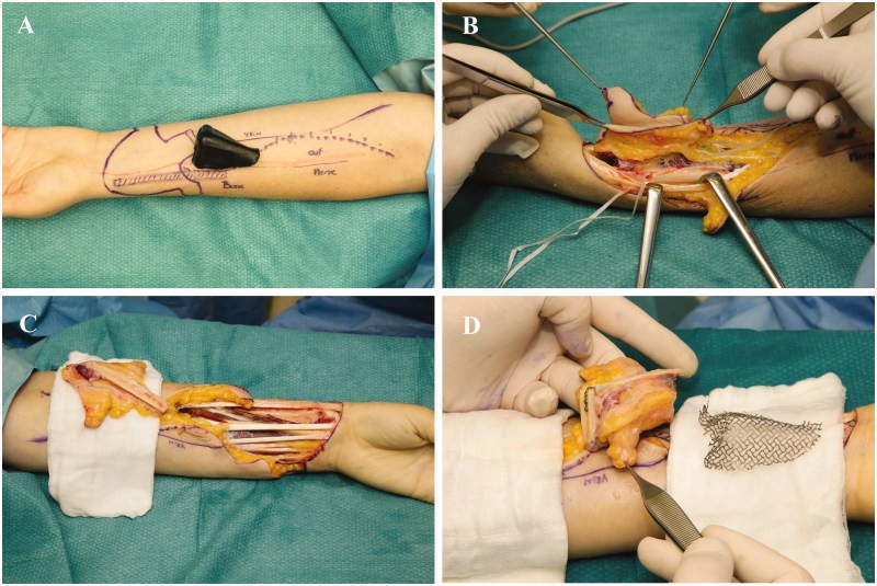 Radial forearm flap raised with a segment of radius