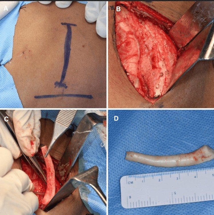 Harvest of a costochondral graft