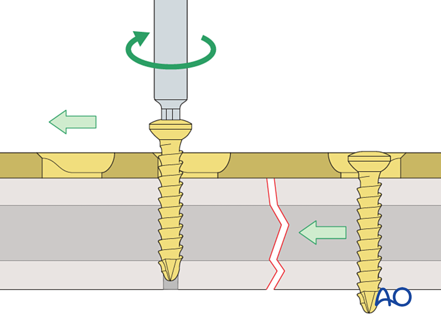 Tightening the eccentric screw moves the fragment toward the fracture