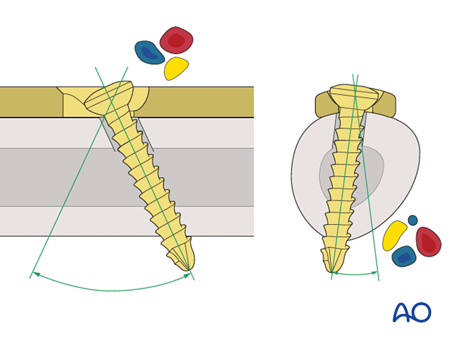 Screw angulation within the plate hole
