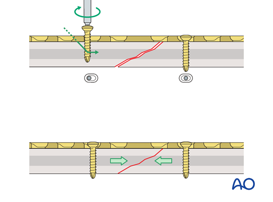 Compression of an oblique fracture into the axilla between plate and bone
