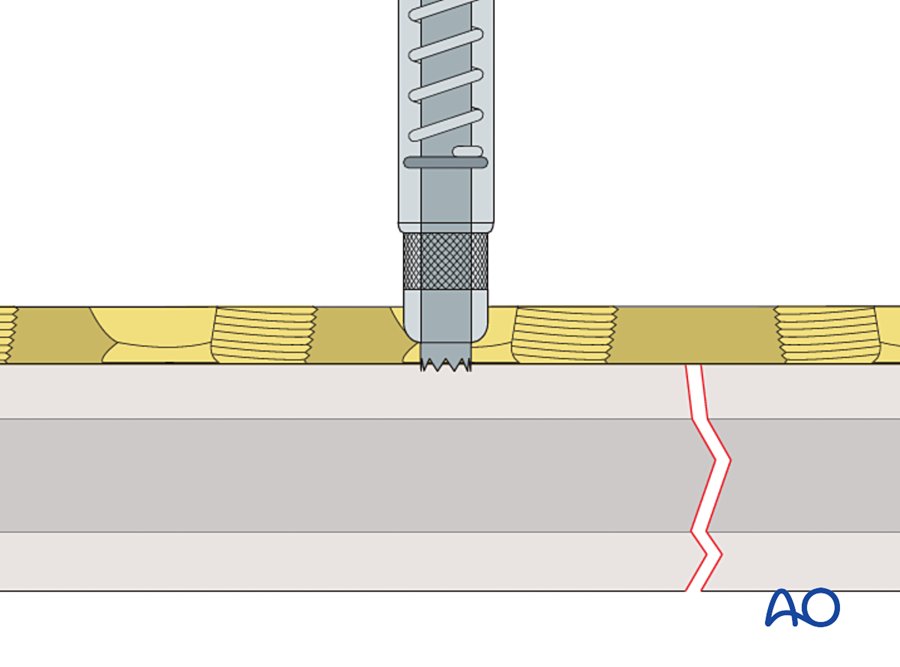 Combination hole of a locking compression plate