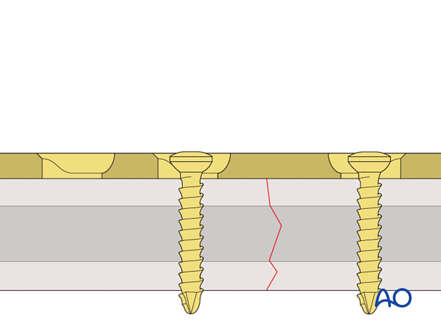 Fracture gap closed and compressed