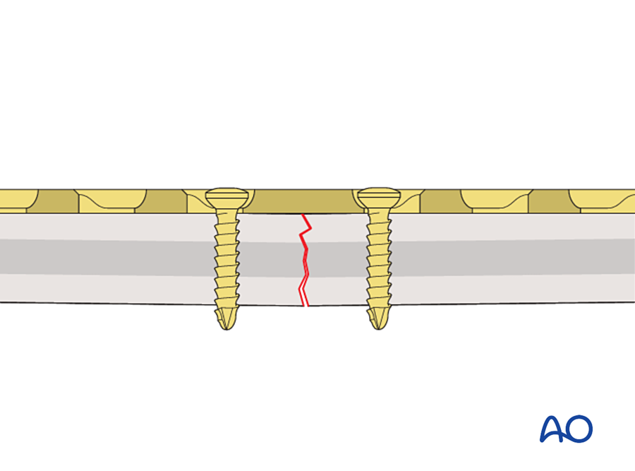 Gap at the far cortex when a straight plate is compressed