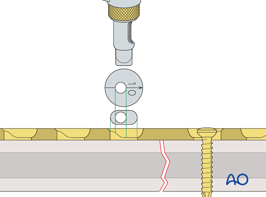 Load drill guide with gold collar, drill channel 1.0 mm eccentric