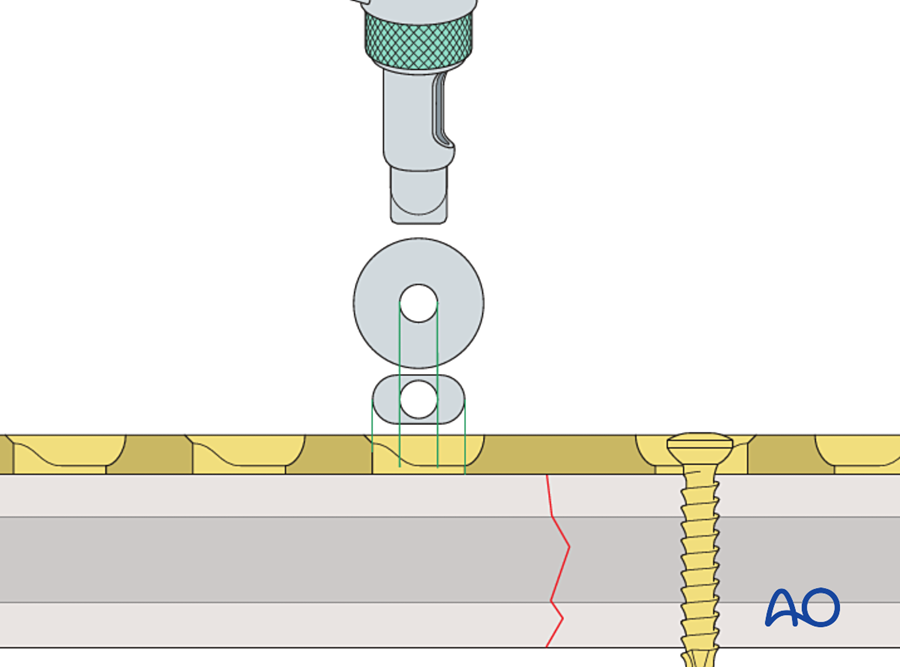 Neutral drill guide with green collar, drill channel central